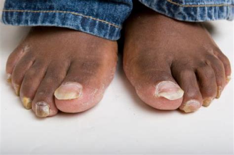 What Causes Thick Toenails Staying Healthy