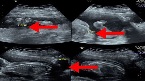 How To Read An Ultrasound Picture Youtube