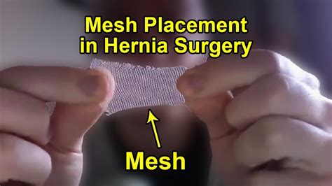 How To Place Mesh In Robotic Hernia Surgery Mesh Placement Technique
