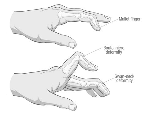 Common Hand And Wrist Injuries In Striking Sports Part 9 Finger