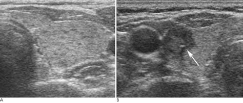 Ultrasonographic Findings Of Papillary Thyroid Cancer With Or Without