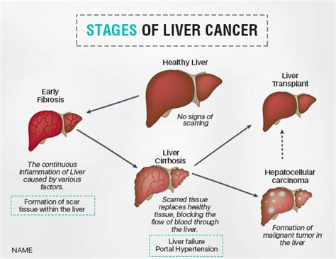 Liver Cancer Treatment Risk Symptoms And Causes Ailbs