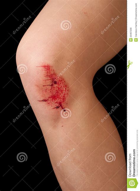 Vertical Closeup Of A Skinned Or Scraped Knee Stock Image Image Of