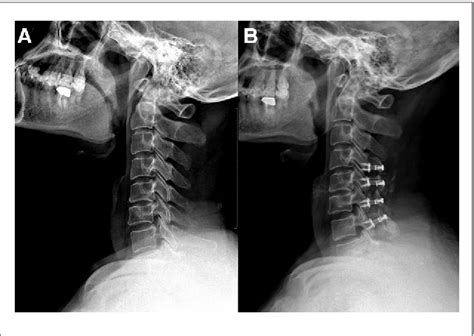 Figure 1 From The Discrepancy Between Preoperative Cervical Sagittal