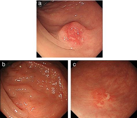 A Case Of Rectal Tumor In Which The Shape Altered With Regression In