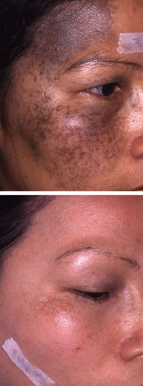 3 Home Remedies For Pigmentation Marks Justinboey