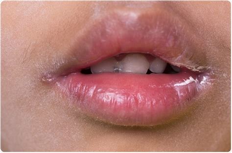 White Patches On Lips Corner