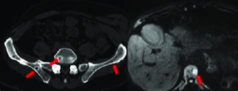 Ct And Mri Images Showing Multiple Vertebral And Iliac Lytic Lesions