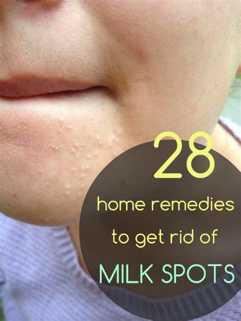28 Useful Home Remedies To Get Rid Of Milia Milk Spots Skin