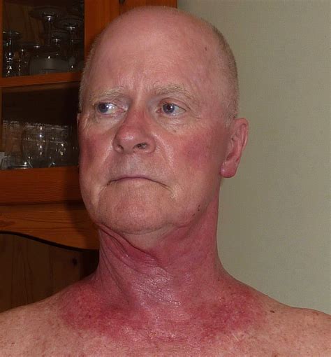 Effects Of Radiation Treatment The Skin Has Reacted Severe Flickr