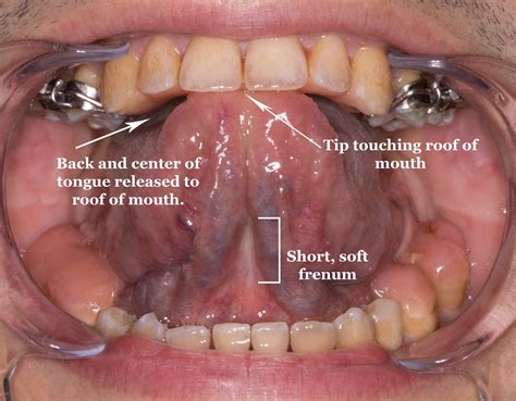 I Finally Figured Out Proper Tongue Posture — Jaw Hacks
