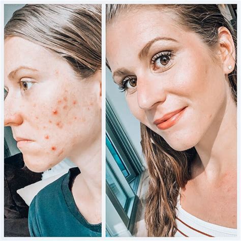 Part 2 5 Best Hormonal Cystic Acne Supplements That Actually Work