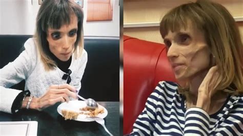 Anorexic Woman So Thin She Could Play A Living Corpse In Horror Movie