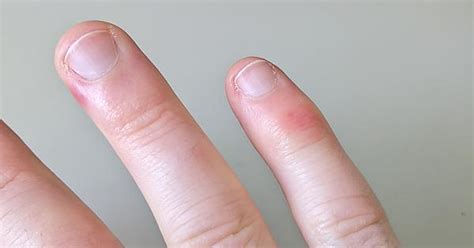 finger swelling bump sore problems album on imgur