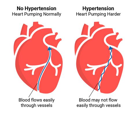 What Is Hypertension And Normal Blood Pressure