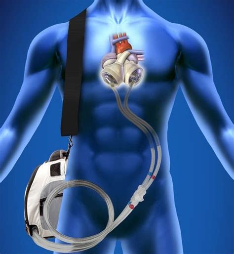 Taking Heart From Wearable Tech Artificial Heart Heart Transplant