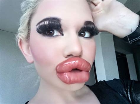 Instagram Viral Mujer Se Inyecta 20 Veces En Los Labios Buscando Tener