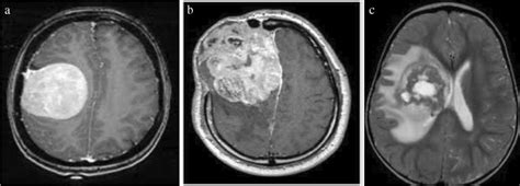 A Brain Tumor Mr Image B Benign C Malignant Meningioma Download