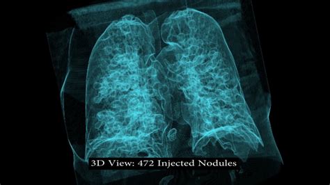 Metastasis Of Pleural Mesothelioma