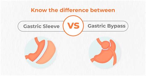 Know The Difference Between Gastric Sleeve Vs Gastric Bypass Gastric