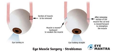 Eye Muscle Surgery Facts Procedure Recovery And Risks Eyemantra