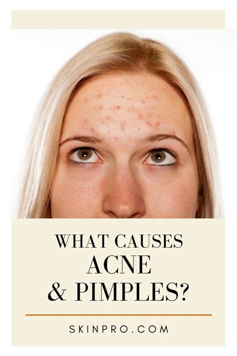 Tips On How To Get Rid Of Pimples Ad Acnes Skin Pro Acneremedies