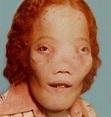 10 Heart-Rending Facts About Rocky Dennis, Whose Rare Deformity Was The ...