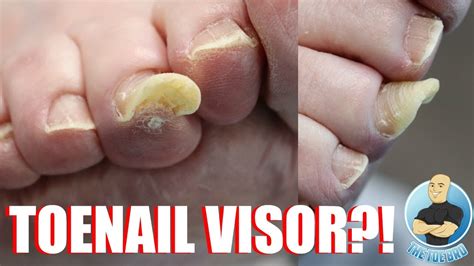 Thick Toenails Causes Treatments And Prevention