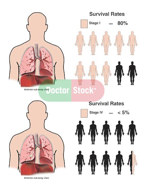 Lung Cancer Survival Rates Doctor Stock