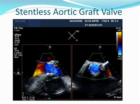 Ppt Echocardiographic Evaluation Of Prosthetic Valves Part I