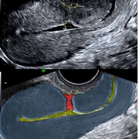 Sagittal Plane Of The Uterus Obtained Transvaginally 6 Weeks After Cs