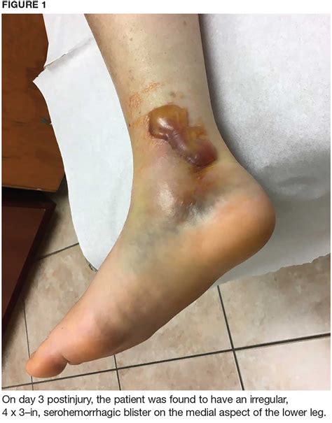 Woman 57 With Painful Swollen Ankle Clinician Reviews