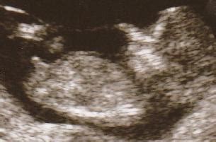 Wann kann ich frühestens einen schwangerschaftstest machen? Wann kann man per Ultraschall das Geschlecht erkennen ...