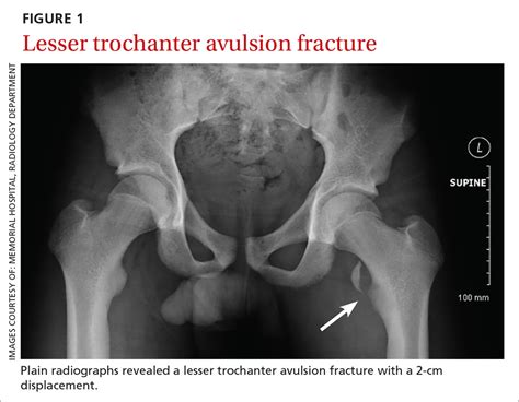 Trochanteric Fracture