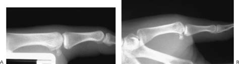 Ulnar Collatreal Ligament Injuries Skiers Thumb Plastic Surgery Key