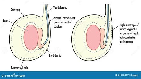 Normal Testicle And Testicle With High Tunica Vaginalis Illustration