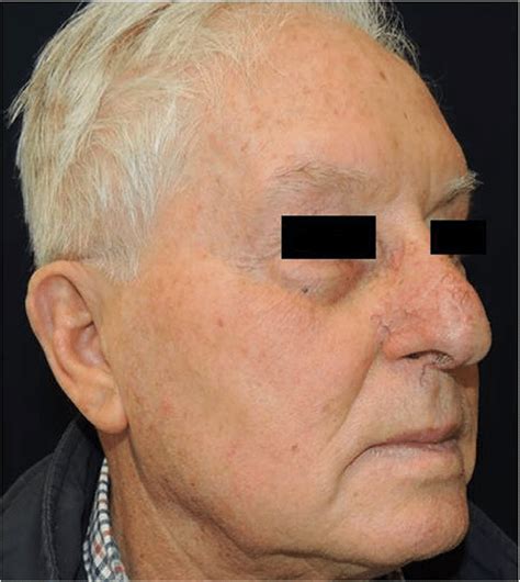 Basal Cell Carcinoma Of The Nasal Tip Area Planning Of The Surgical