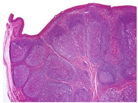 Pharyngeal Tonsils Histology Labeled