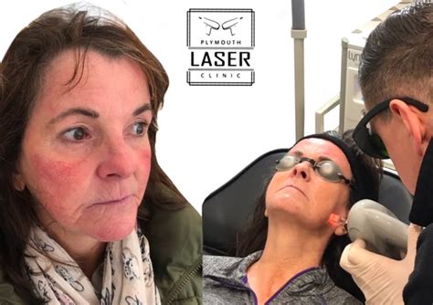 Gallery Plymouth Laser Clinic