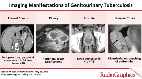 Imaging Manifestations Of Genitourinary Tuberculosis RadioGraphics