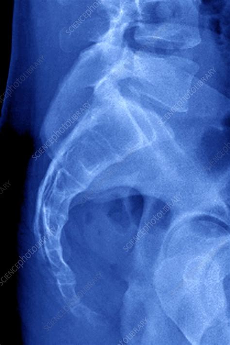 Healthy Sacrum And Coccyx X Ray Stock Image C0096746 Science