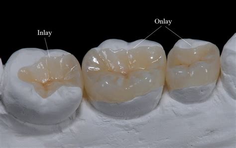 Composite Inlays And Onlays Premier Dental Center Ferndale Wa