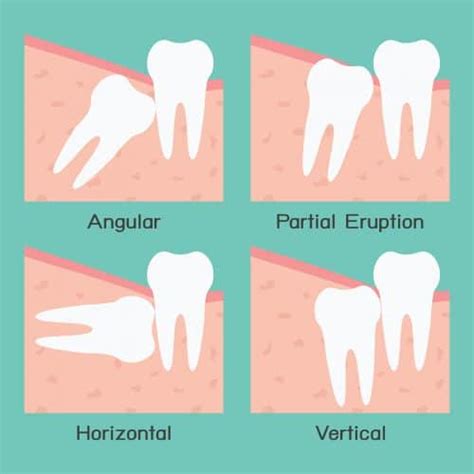 Are Your Wisdom Teeth Impacted Eagle Rock Dental