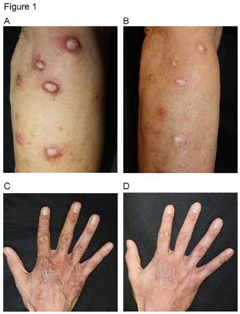 Figure 1 From Intractable Prurigo Nodularis Successfully Treated With