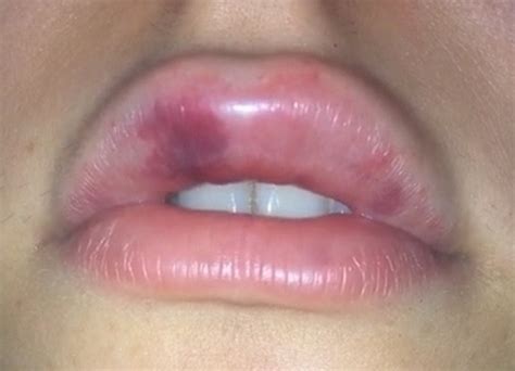 Bruising After Lip Filler Injection And How To Treat It Dr Abbas