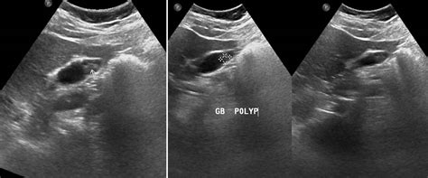Gallbladder Polyp Radiology Cases