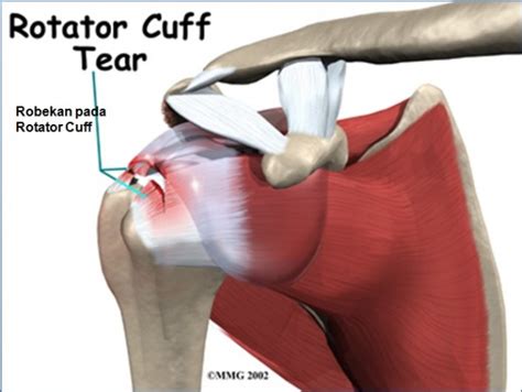 Rotator Cuff Disorders 👨‍⚕️singapore Orthopaedic And Neurosurgery Clinic
