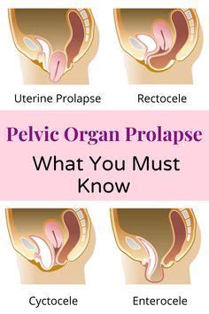 What Is Pelvic Organ Prolapse Causes Symptoms FemiCushion