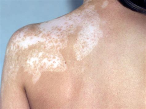 الفطريات الجلدية تعتبر من الامراض الشائعة التي تصيب الجلد و البشرة