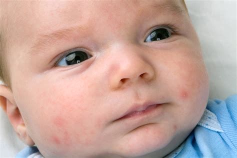 Common Skin Rashes In Infants